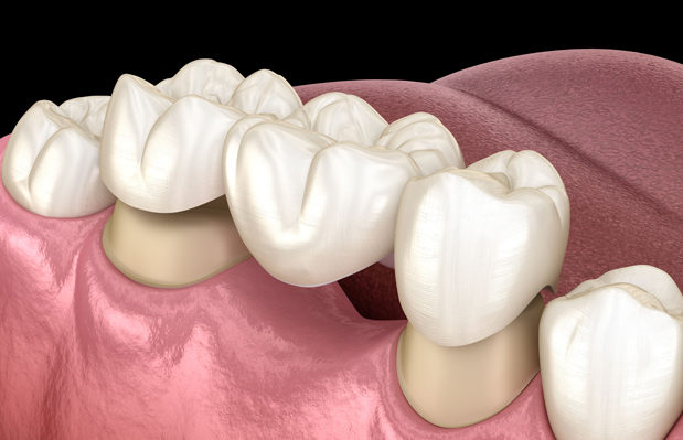 What Are Dental Bridges