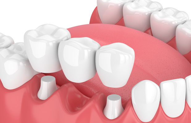 Why Are Dental Bridges Needed