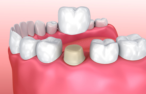 Why Are Dental Crowns Needed