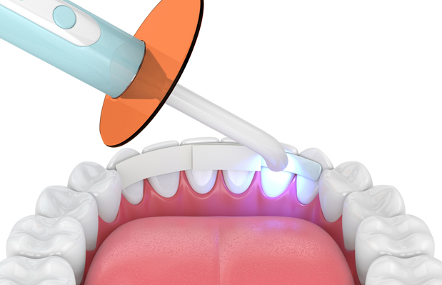 Why Is Dental Bonding Needed