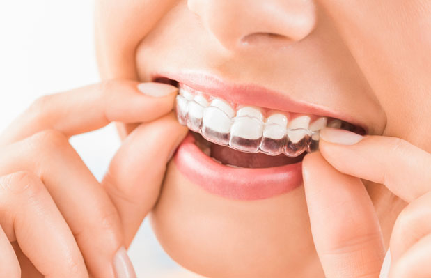 What Is Invisalign